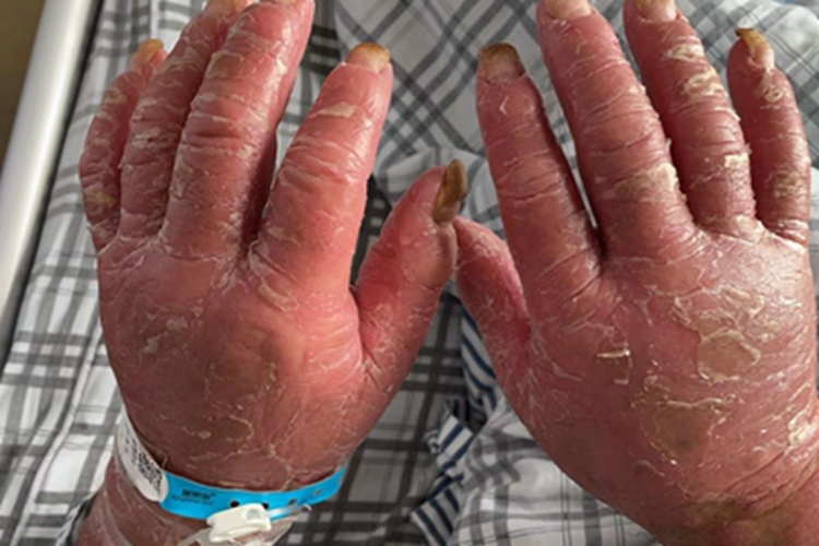 红皮病型银屑病手部红肿图