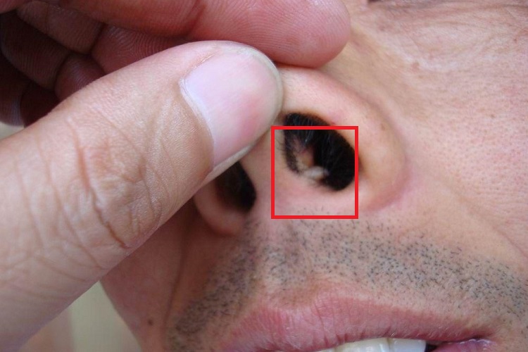 疣鼻部症状图 疣鼻部症状图