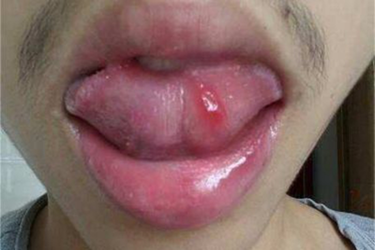 创伤性溃疡症状图 创伤性溃疡症状图