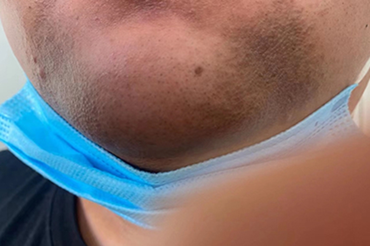 皮肤黑变病下巴黑斑图 皮肤黑变病下巴黑斑图