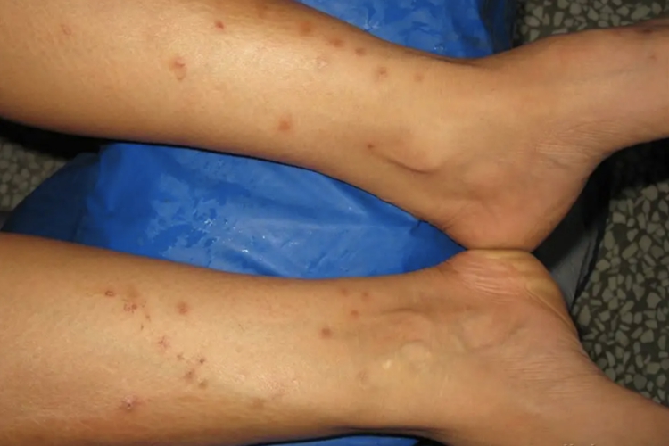 小腿虫咬皮炎皮损图