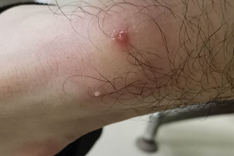 昆虫性皮炎脚踝脓包图