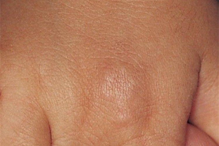 硬化性脂肪肉芽肿手背长结节图