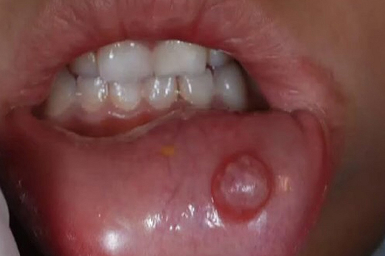 黏液腺囊肿嘴唇长水疱图