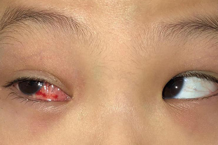 斜视手术后眼白有裂开图