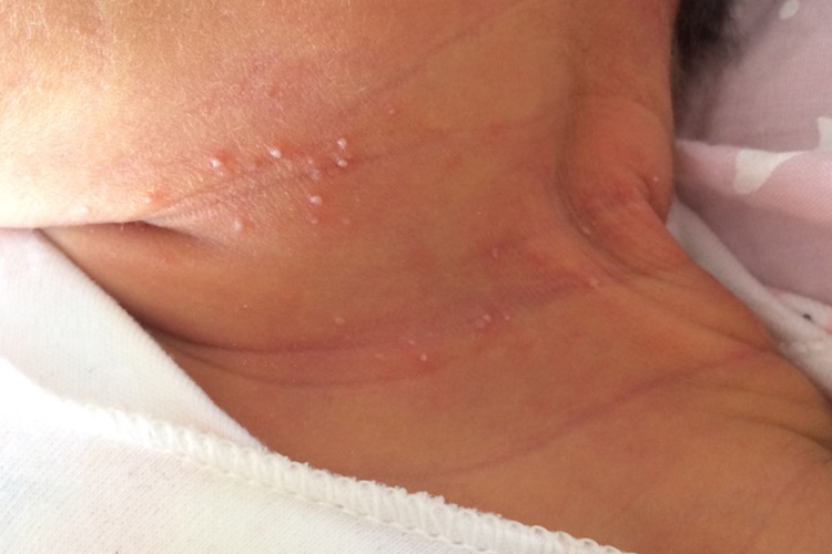 脖子上长白痱图