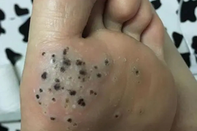 黑头粉刺痣黑斑图