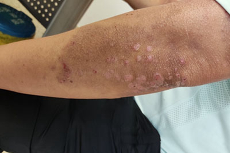 慢性湿疹胳膊小疙瘩图