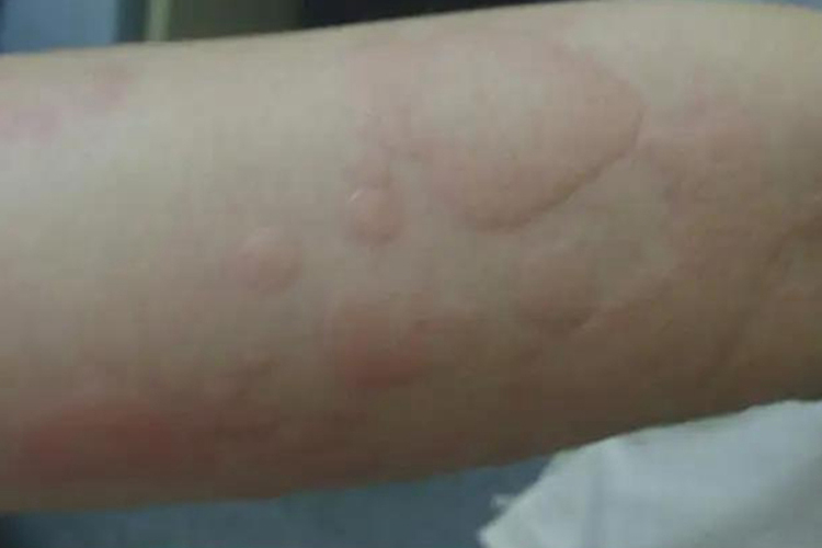 荨麻疹型药疹图