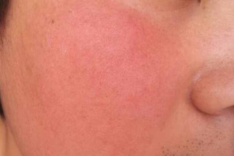 男人肾阴虚脸部症状图