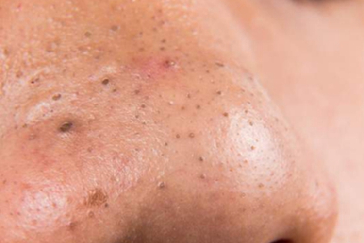 黑头鼻子有大小不一的黑点图