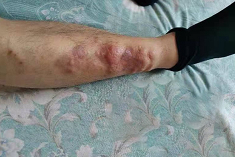 胫前黏液性水肿小腿症状图