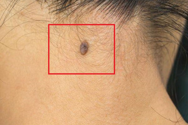 皮内痣后颈症状图