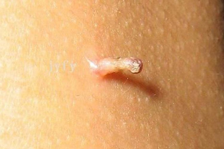 丝状疣大腿内侧长了个肉芽状疣体图