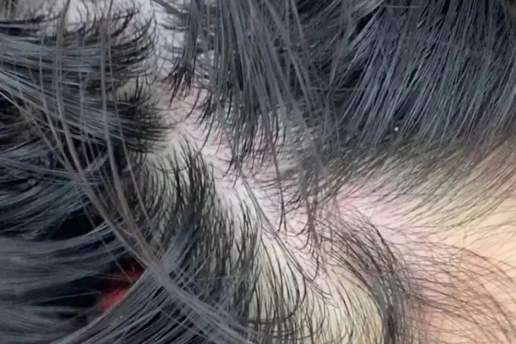 洗发水过敏症状图