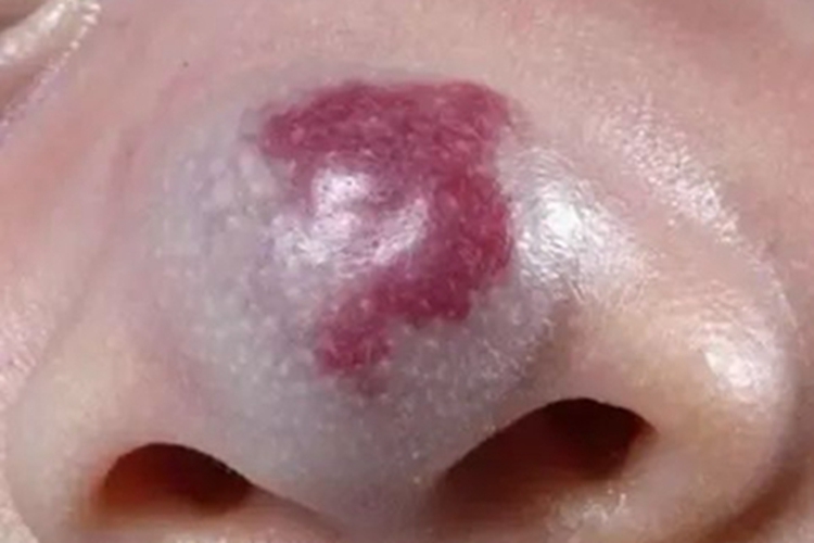 混合型婴儿血管瘤图 混合型婴儿血管瘤图