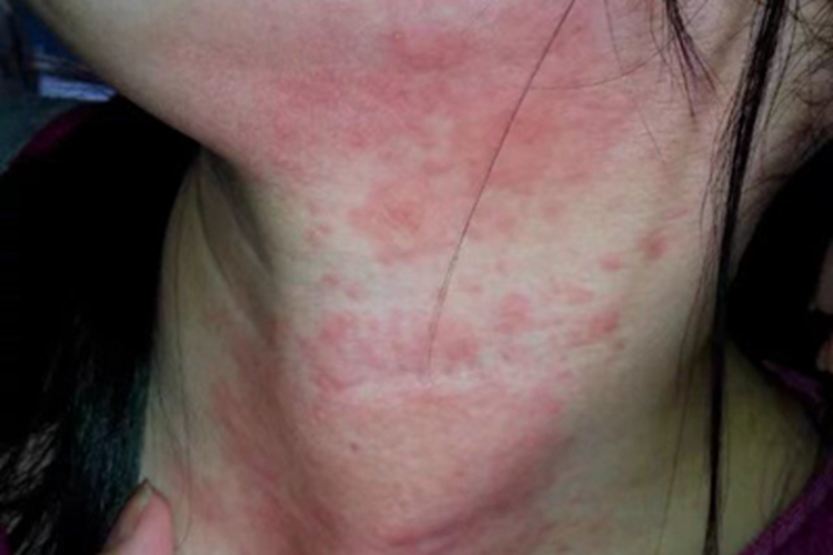 红痱颈部红斑图 红痱颈部红斑图