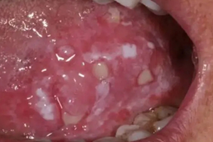 二期口腔梅毒舌侧症状图