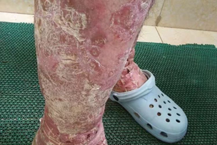 红皮病脱屑期小腿脱屑图