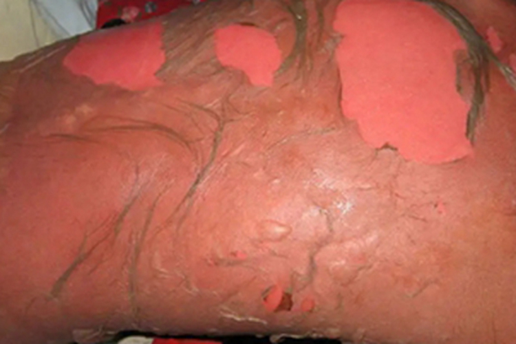 中毒性表皮坏死松解症脱皮图