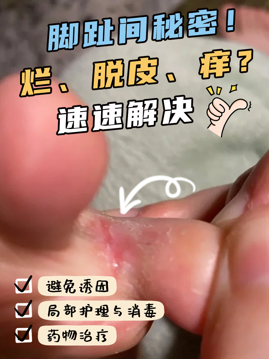脚趾间秘密！烂、脱皮、痒？速速解决
