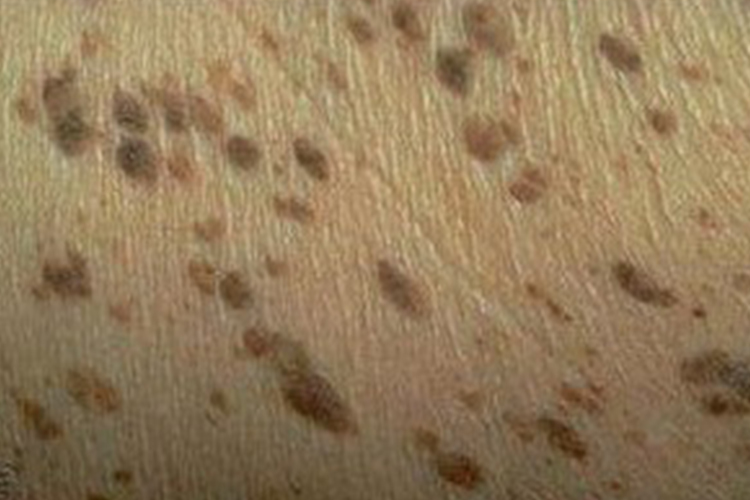 脂溢性角化病图 脂溢性角化病图