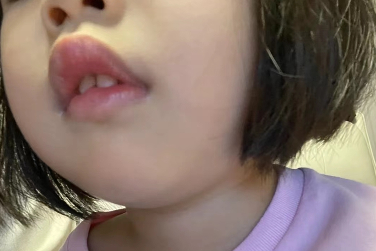 2岁患儿腺样体肥大面容