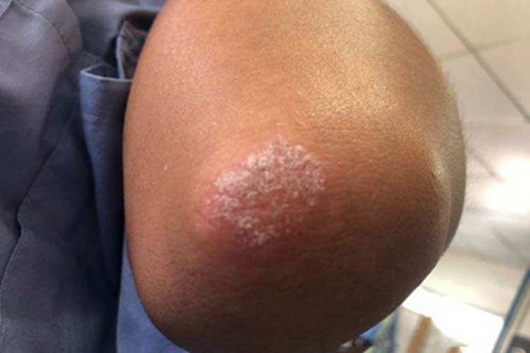 慢性苔藓样角化病症状图片