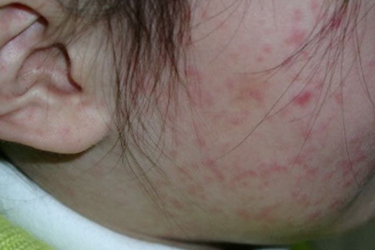 轻型麻疹面部有小丘疹图