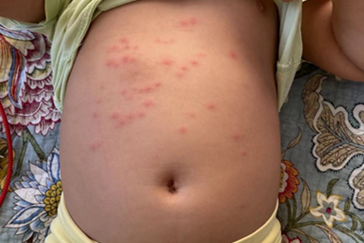 丘疹性荨麻疹腹部症状图 丘疹性荨麻疹腹部症状图