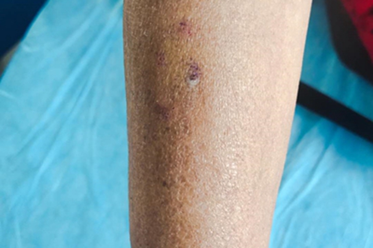 萎缩性慢性肢端皮炎症状图