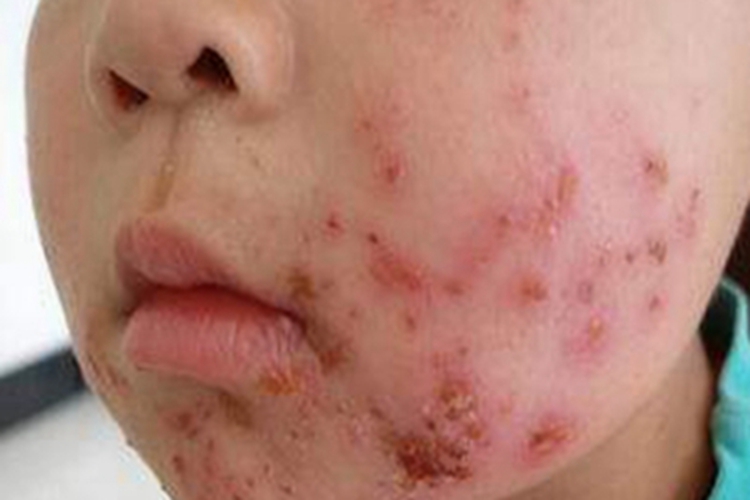 急性点滴型儿童银屑病面部结痂图