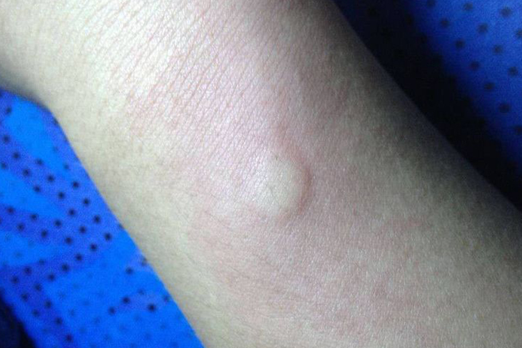 青霉素皮试阳性图