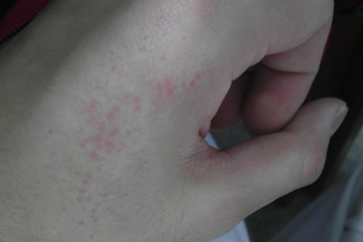 冷球蛋白血症性紫癜手背红点图