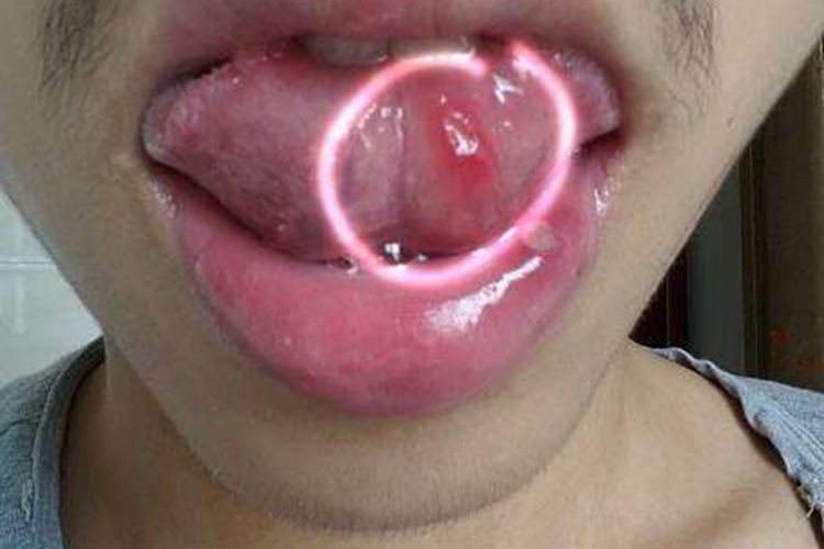 复发性口腔溃疡圆形红斑图