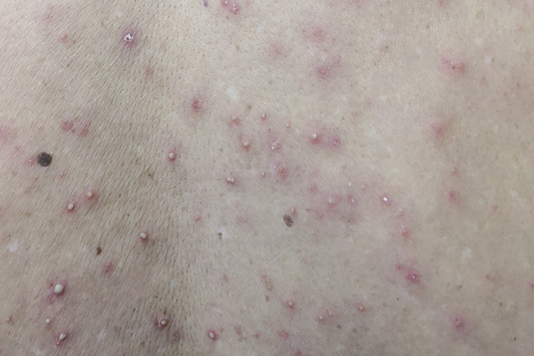 脓疱图 脓疱图