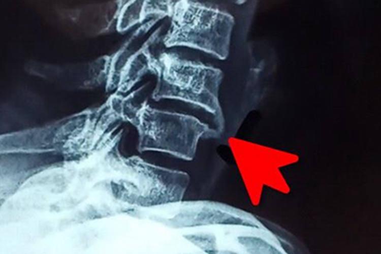 骨质增生骨桥图 骨质增生骨桥图