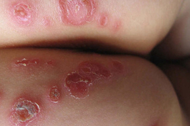 角层下脓疱性皮病臀部脱皮图