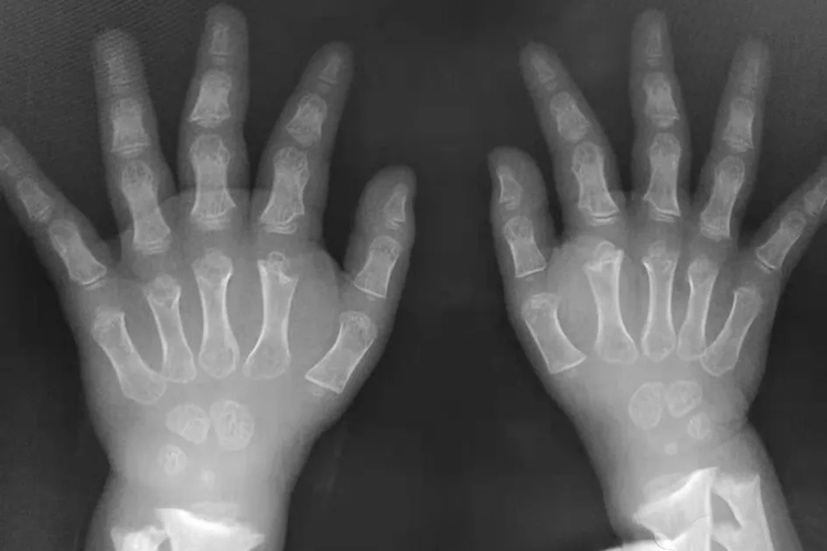 软骨发育不良三叉戟手图 软骨发育不良三叉戟手图