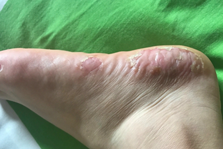 疱疹样脓疱病脚后跟症状图