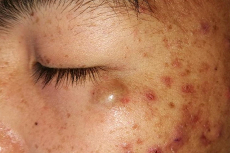 皮样囊肿肿块图