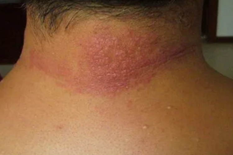 夏季皮炎后颈大片红斑图