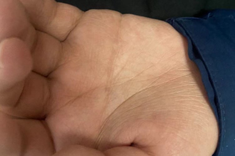 唐氏综合征手掌纹图