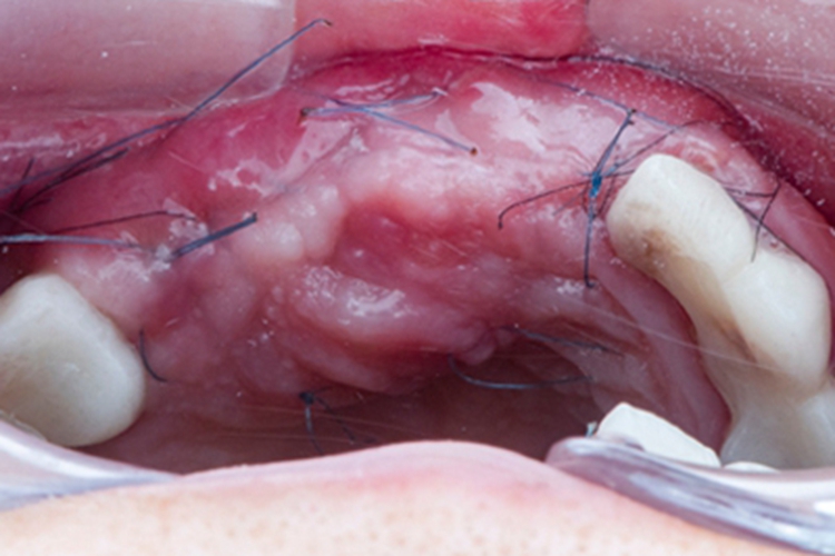 种植牙一期伤口新生组织图 种植牙一期伤口新生组织图