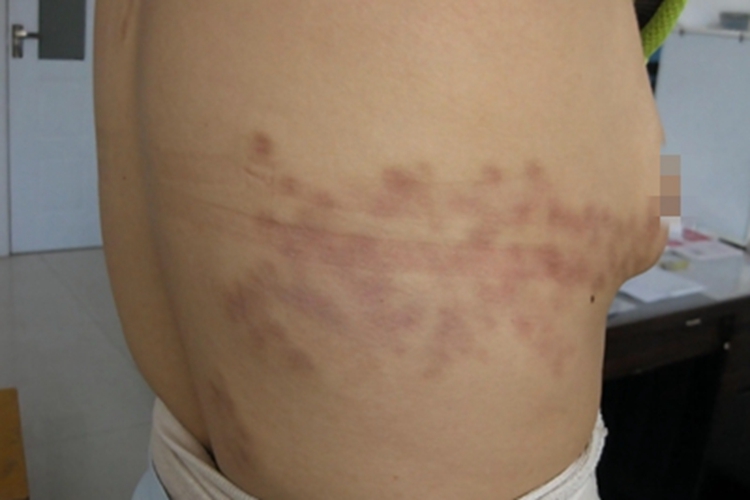 蕈样肉芽肿肋部症状图 蕈样肉芽肿肋部症状图