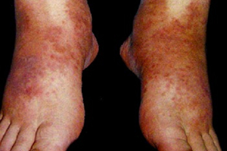 结节性多动脉炎小红疙瘩图