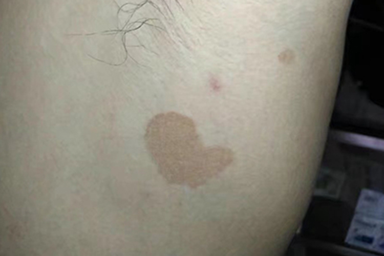 花斑癣腋下有斑图 花斑癣腋下有斑图