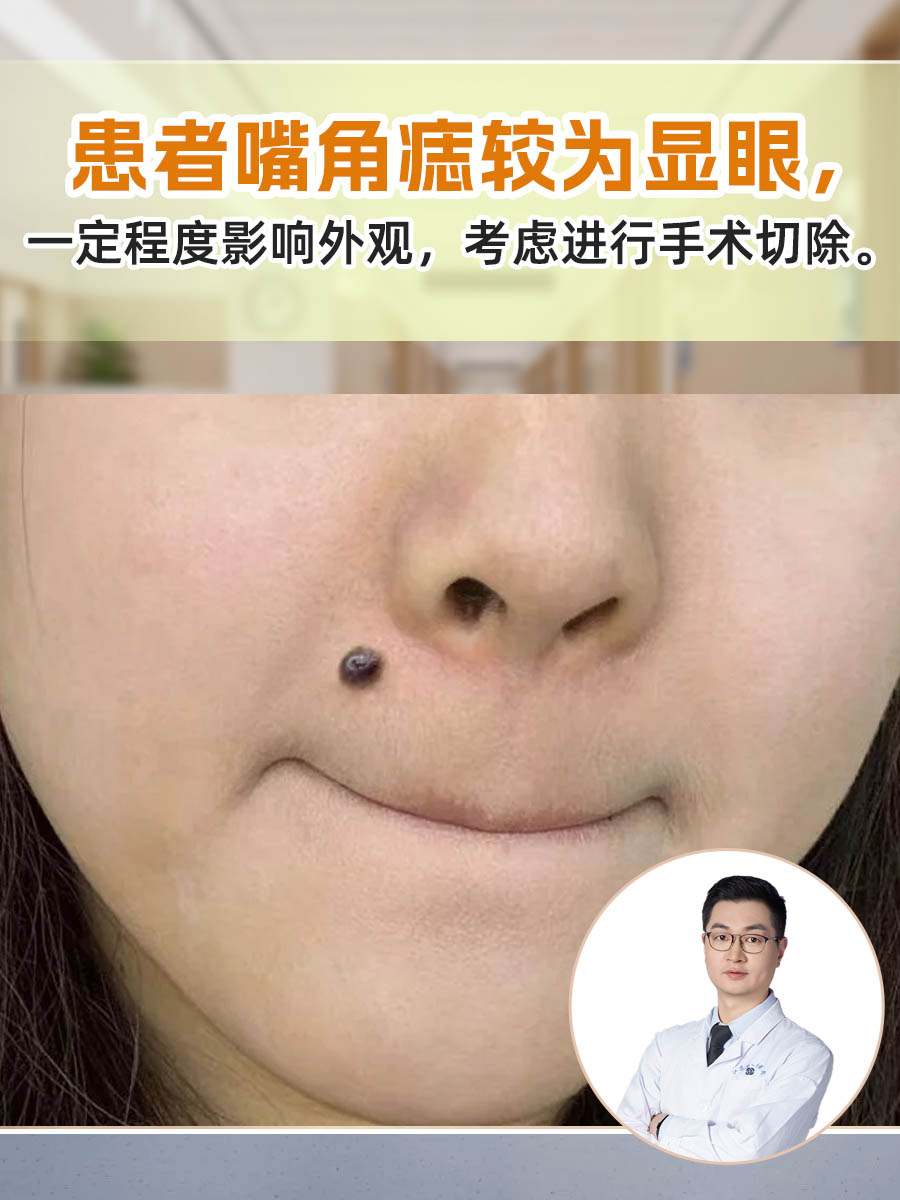 见证一颗痣的消失,了解切除痣的手术过程