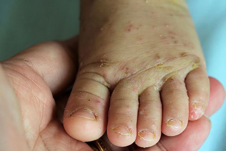疥疮脚背疙瘩图