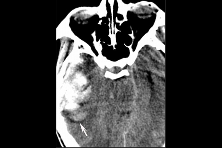 脑挫裂伤CT图 脑挫裂伤CT图